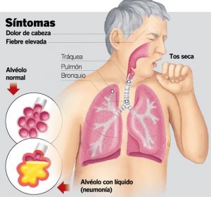 sintomas neumonia