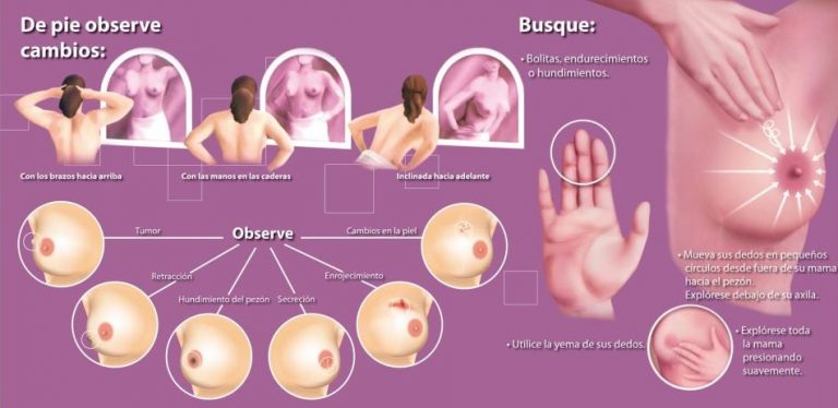 cancer de mama