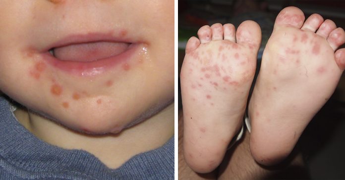 virus-boca-mano-pie-banner-696x364