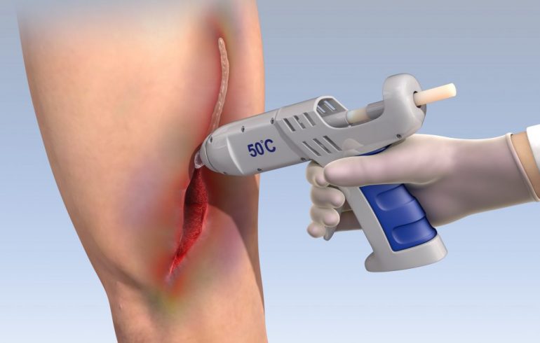 Pegamento sella heridas graves