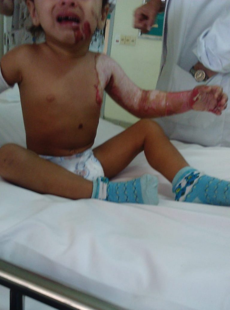 Renata -niña quemada