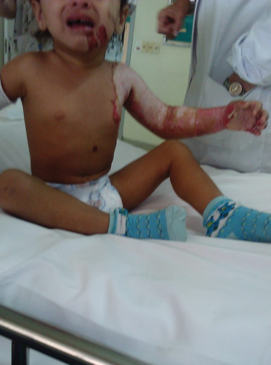 Renata -niña quemada