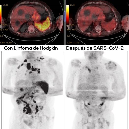 Paciente con Linfoma