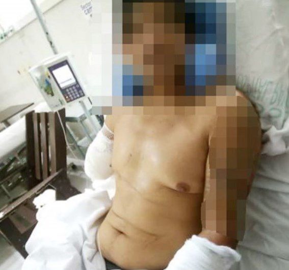 Hombre amputado en el hospital