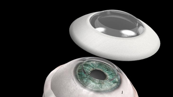 Implante córnea artificial