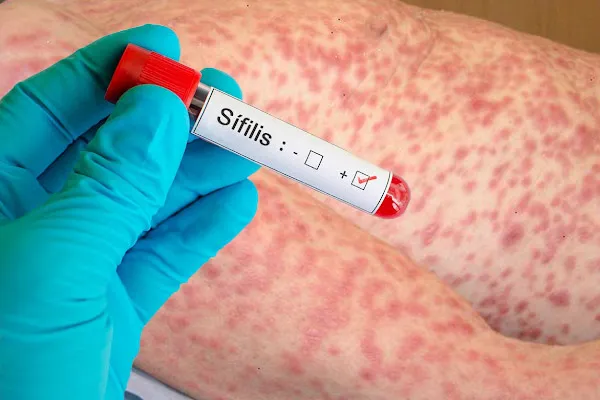 Sífilis