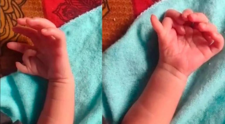 Niña de la india con 26 dedos